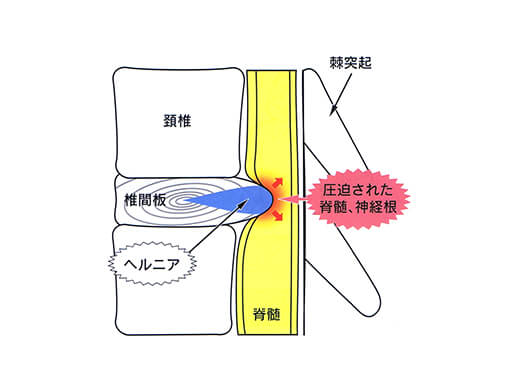 頚椎椎間板ヘルニアの病態