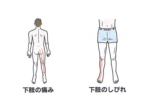 腰部脊柱管狭窄症の症状