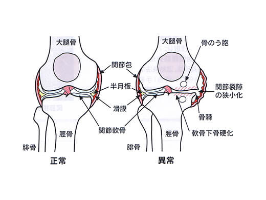 変形性膝関節症の原因・病態