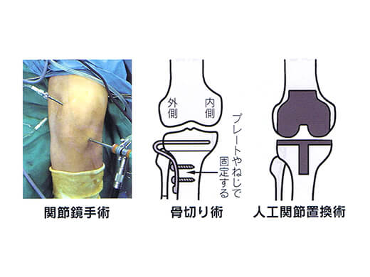 変形性膝関節症の治療法