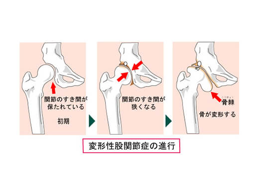 変形性股関節症の病態