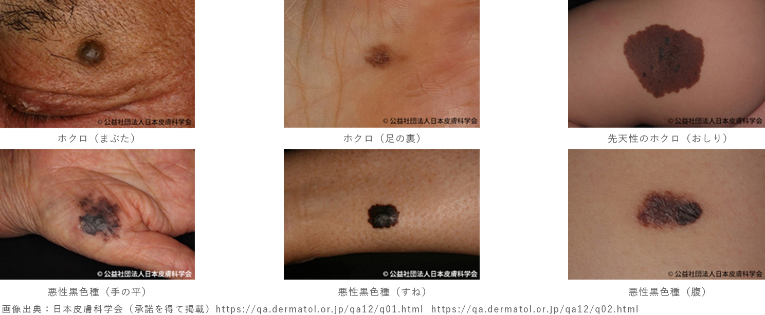 皮膚科 ホクロ | 小早川整形外科・内科・皮膚科（豊田市）