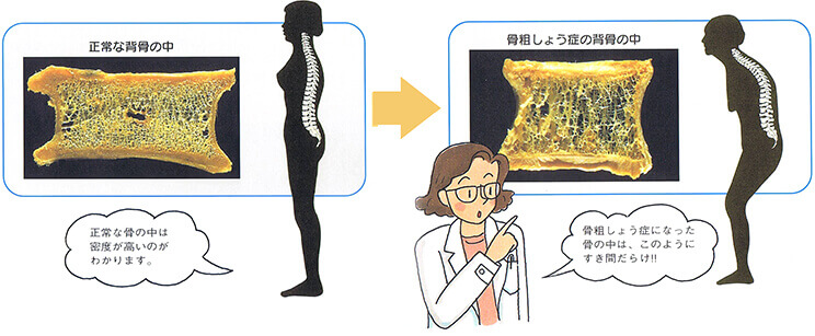 骨粗しょう症とは？