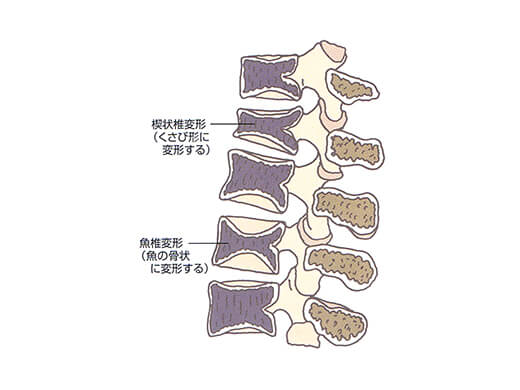 骨粗しょう症の病態