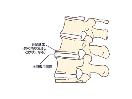 変形性脊椎症の症状